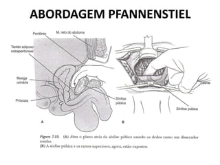 ABORDAGEM PFANNENSTIEL
 
