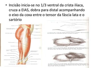 • Incisão inicia-se no 1/3 ventral da crista ilíaca,
cruza a EIAS, dobra para distal acompanhando
o eixo da coxa entre o tensor da fáscia lata e o
sartório
 
