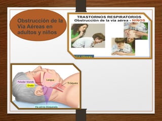 • Obstrucción de la
Vía Aéreas en
adultos y niños
 