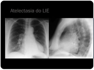 Atelectasia do LIE
 