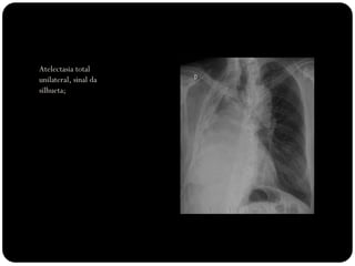 Atelectasia total
unilateral, sinal da
silhueta;
total unilateral
 
