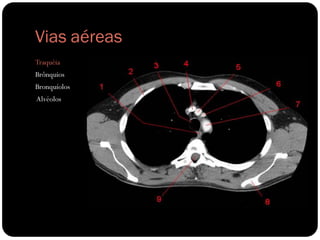 Vias aéreas
Traquéia
Brônquios
Bronquíolos
Alvéolos
 