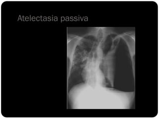 Atelectasia passiva
 