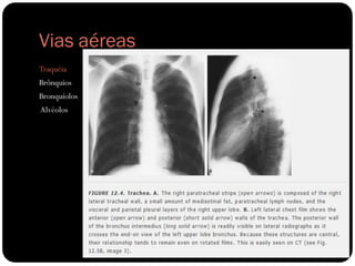 Vias aéreas
Traquéia
Brônquios
Bronquíolos
Alvéolos
 