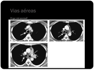 Vias aéreas
O que está anormal?
 