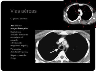 Vias aéreas
O que está anormal?


Amiloidose
traqueobrônquica
Depósitos de
amilóides de maneira
circunferencial
causando
estreitamento
irregular da traquéia;
Pneumonia e
atelectasia frequente;
Biópsia – vermelho
Congo
 