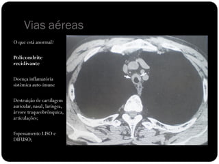 Vias aéreas
O que está anormal?

Policondrite
recidivante

Doença inflamatória
sistêmica auto-imune

Destruição de cartilagem
auricular, nasal, laríngea,
árvore traqueobrônquica,
articulações;

Espessamento LISO e
DIFUSO;
 