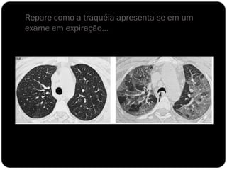 Repare como a traquéia apresenta-se em um
exame em expiração...
 