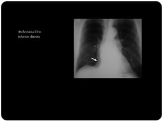 Atelectasia lobo
inferior direito
 