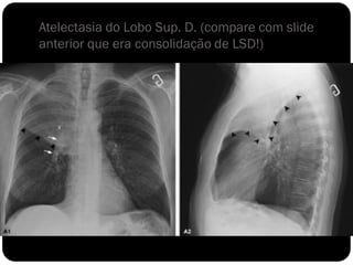 Atelectasia do Lobo Sup. D. (compare com slide
anterior que era consolidação de LSD!)
 