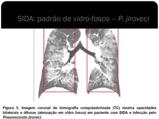 SIDA: padrão de vidro-fosco – P. jiroveci
 
