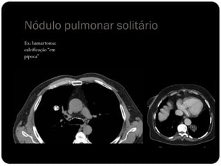 Nódulo pulmonar solitário
Ex: hamartoma:
calcificação “em
pipoca”
 