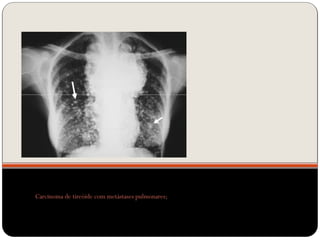 Carcinoma de tireóide com metástases pulmonares;
 