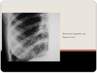 Histiocistose Langerhans com
Pequenos cistos;
 