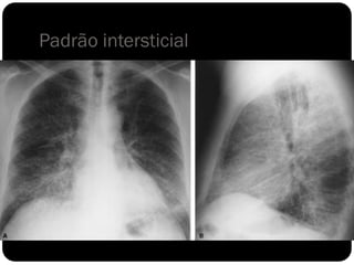 Padrão intersticial
 