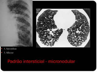  1. Sarcoidose
 2. Silicose



      Padrão intersticial - micronodular
 