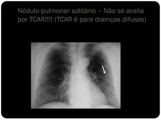 Nódulo pulmonar solitário – Não se avalia
por TCAR!!!! (TCAR é para doenças difusas)
 