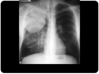 Grande massa no lobo superior direito
 