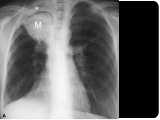 Bola fúngica
(aspergiloma) em
cavidade
 
