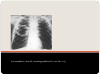 Carcinoma broncoalveolar escavado (quando necrótico ou infectado)
 