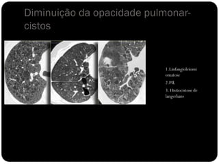 Diminuição da opacidade pulmonar-
cistos


                            1.Linfangioleiomi
                            omatose
                            2.PIL
                            3. Histiocistose de
                            langerhans
 