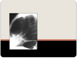 Bolhas de enfisema avançado
 