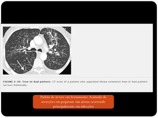 Padrão de árvore em brotamento: Acúmulo de
 secreções em pequenas vias aéreas ocorrendo
         principalmente em infecções
 