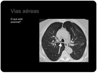Vias aéreas
O que está
anormal?
 