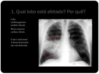 1. Qual lobo está afetado? Por quê?
Lobo
médio(segmento
medial e lateral;
Borra contorno
cardíaco direito
E não é atelectasia!
A fissura horizontal
não está deslocada.
 