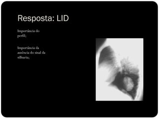 Resposta: LID
Importância do
perfil;
Importância da
ausência do sinal da
silhueta;
 