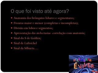 O que foi visto até agora?
 Anatomia dos brônquios lobares e segmentares;
 Fissuras maior e menor (completas e incompletas);
 Divisão em lobos e segmentos;
 Apresentação das atelectasias- correlação com anatomia;
 Sinal do S de Golden;
 Sinal de Luftsichel
 Sinal da Silhueta....
 