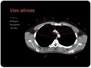Vias aéreas
Traquéia
Brônquios
Bronquíolos
Alvéolos
 