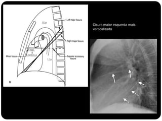 Cisura maior esquerda mais
verticalizada
 