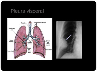 Pleura visceral
 