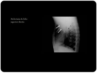 Atelectasia do lobo
superior direito
 