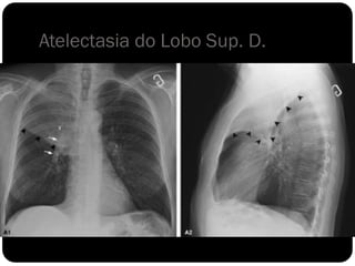 Atelectasia do Lobo Sup. D.
 