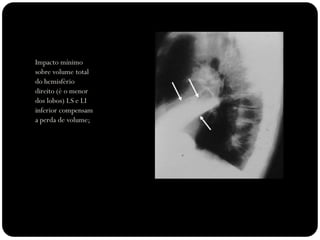 Impacto mínimo
sobre volume total
do hemisfério
direito (é o menor
dos lobos) LS e LI
inferior compensam
a perda de volume;
 