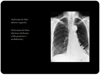 Atelectasia do lobo
inferior esquerdo
Atelectasias de lobos
inferiores deslocam
o hilo posterior e
medialmente;
 