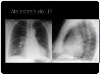 Atelectasia do LIE
 