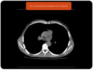 TC com janela para mediastino sem contraste
 