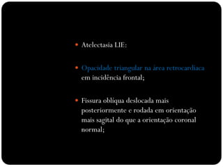  Atelectasia LIE:
 Opacidade triangular na área retrocardíaca
em incidência frontal;
 Fissura oblíqua deslocada mais
posteriormente e rodada em orientação
mais sagital do que a orientação coronal
normal;
 
