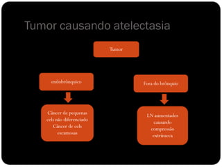 Tumor causando atelectasia
Tumor
endobrônquico Fora do brônquio
Câncer de pequenas
cels não diferenciado
Câncer de cels
escamosas
LN aumentados
causando
compressão
extrínseca
 