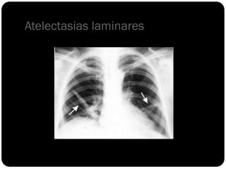 Atelectasias laminares
 