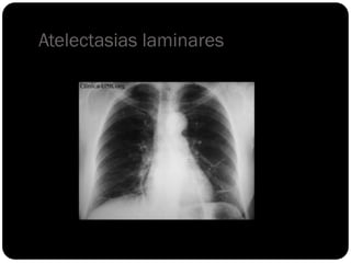 Atelectasias laminares
 