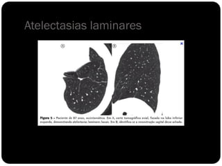 Atelectasias laminares
 
