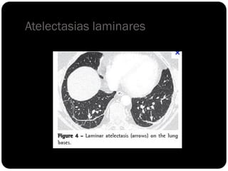 Atelectasias laminares
 