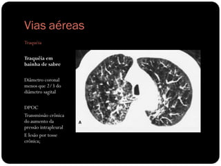 Vias aéreas
Traquéia

Traquéia em
bainha de sabre

Diâmetro coronal
menos que 2/3 do
diâmetro sagital

DPOC
Transmissão crônica
do aumento da
pressão intrapleural
E lesão por tosse
crônica;
 