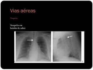 Vias aéreas
Traquéia


Traquéia em
bainha de sabre
 