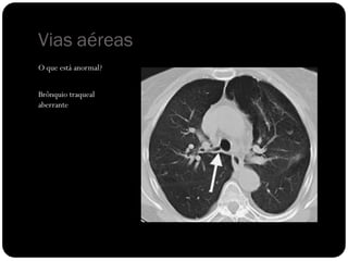 Vias aéreas
O que está anormal?


Brônquio traqueal
aberrante
 
