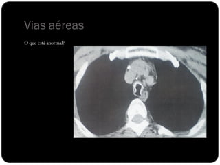 Vias aéreas
O que está anormal?
 